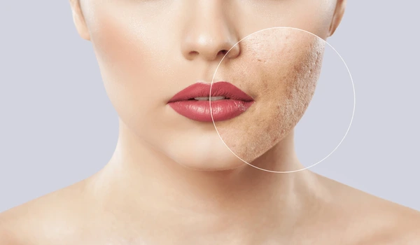 Best Acne Scar Treatment provided by The Velvet Skin Centre Lucknow